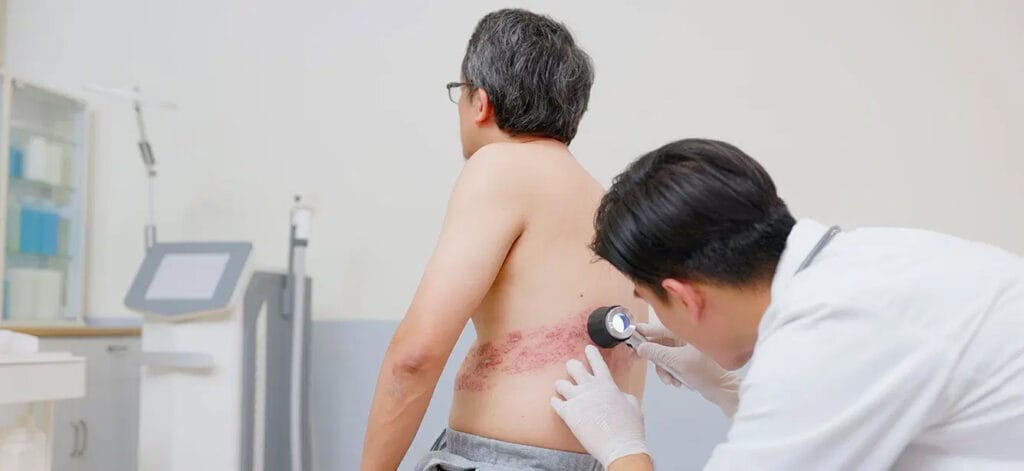 Shingles Doctor Checkup