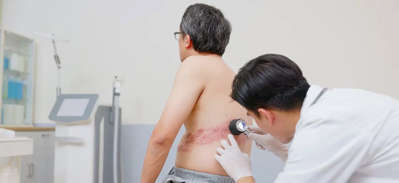 Shingles Doctor Checkup